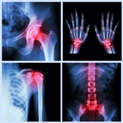 fracture x-rays